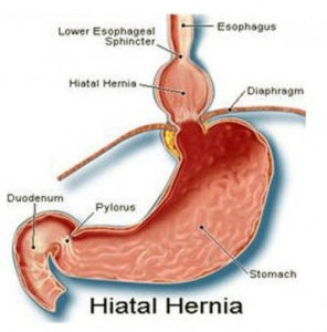 Dr. Gidon Almogy, Hiatal Hernia, Reflux