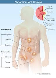 Dr Gidon Almogy, Hernia 