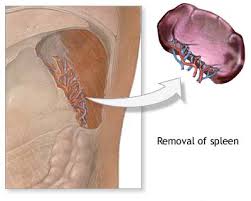 Dr. Gidon Almogy, Splenectomy
